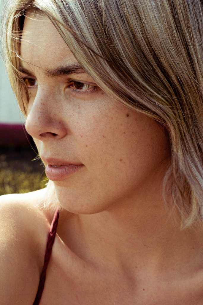 Sivilce Lekelerine Ne İyi Gelir